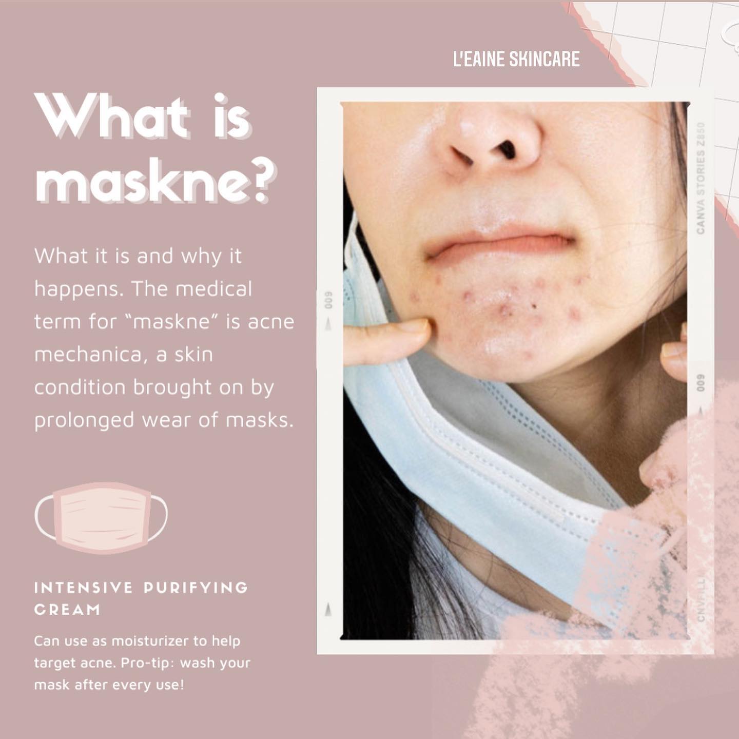 Do you need Maskne facial treatment?